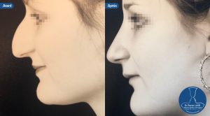 Rhinoplastie 2