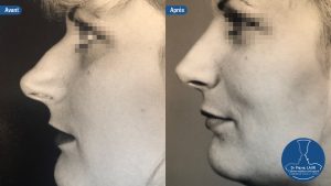 Rhinoplastie 3