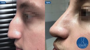 Rhinoplastie 4