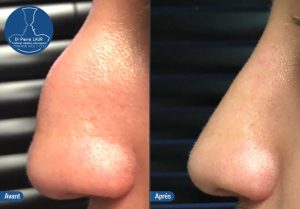 Rhinoplastie 5