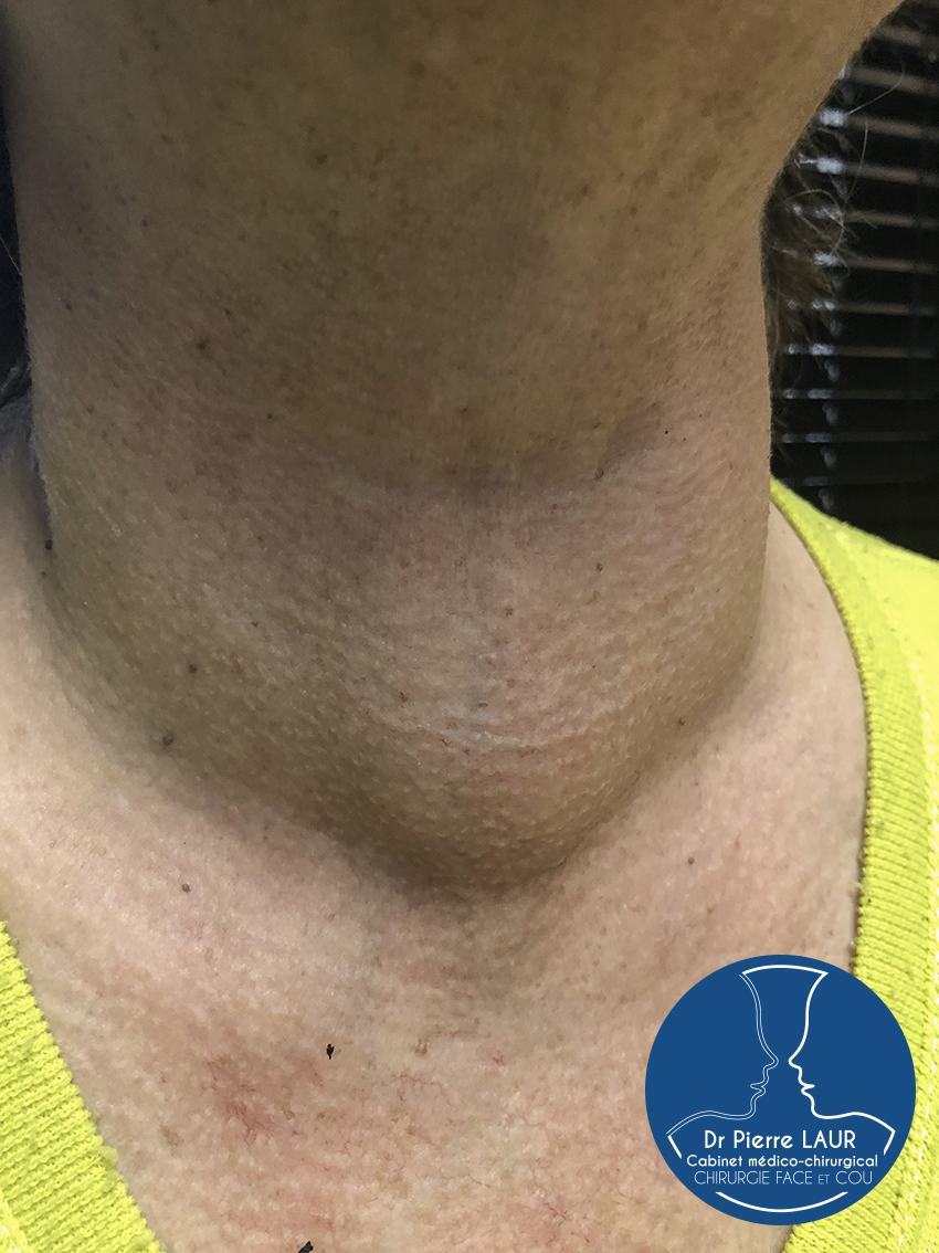 Chirurgie de la Thyroïde 1