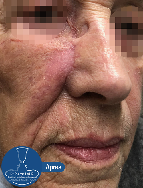 Chirurgie des tumeurs cutanées de la face-Apres 1