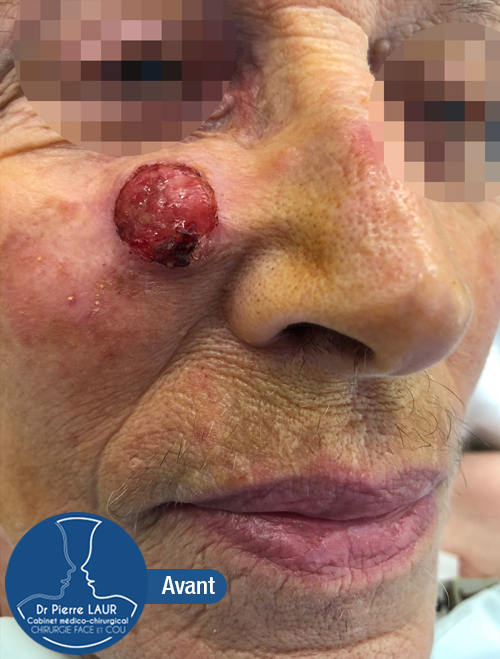 Chirurgie des tumeurs cutanées de la face-Avant 1