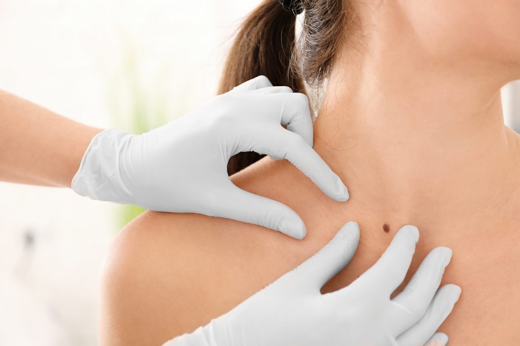 Chirurgie des tumeurs cutanées de la face