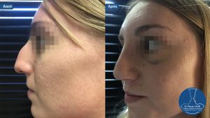 Rhinoplastie1-1024x576