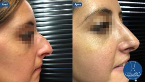 Rhinoplastie2-1024x576