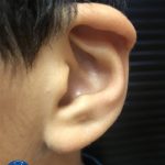 otoplastie-Avant2
