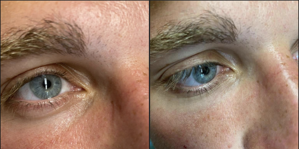 comblez cernes périgueux médecine esthétique