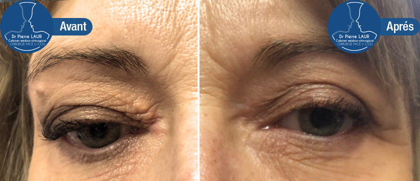 blepharo-Avant:apres-1