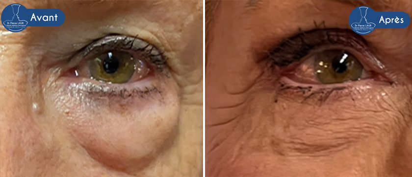 blepharo-Avant:apres-2